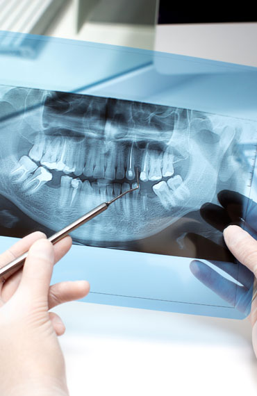 Ortodoncia Invisible en Pachuca